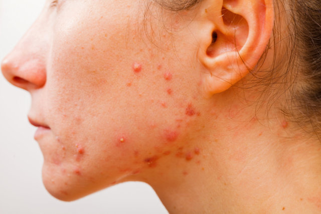 Acne: Common Causes, Symptoms, and More