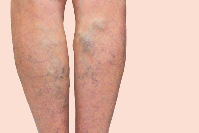 Knowing More About Varicose Veins