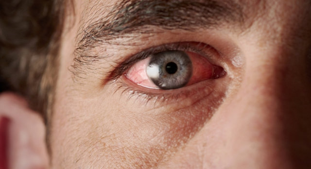 Common Eye Injuries and Their Treatment - 1